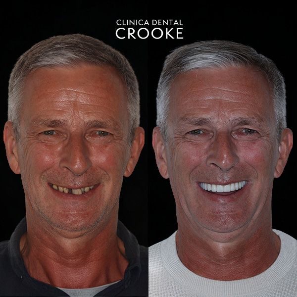 Antes y después del tratamiento, a la izquierda antes y a la derecha después: dientes fijos el mismo día de la cirugía