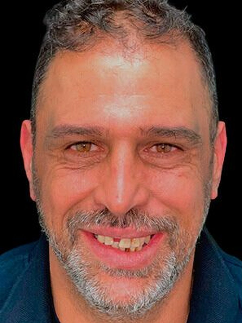 Antes del tratamiento: prótesis fija completa sobre implantes