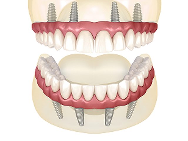 Prótesis fija completa sobre implantes
